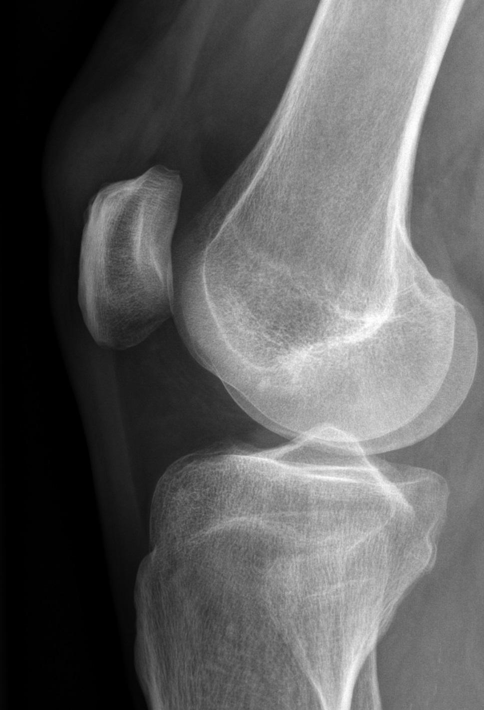 een-zwelling-boven-de-knie-ntvg